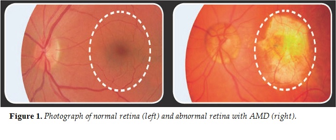 Retina